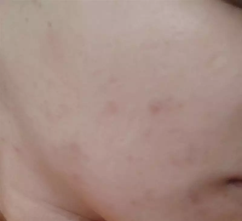 نتیجه مصرف صابون زردچوبه
