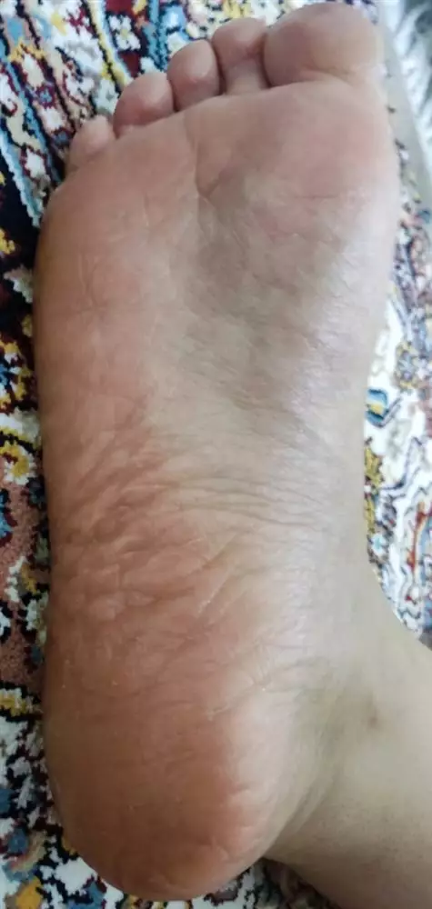 نتیجه مصرف شی باتر