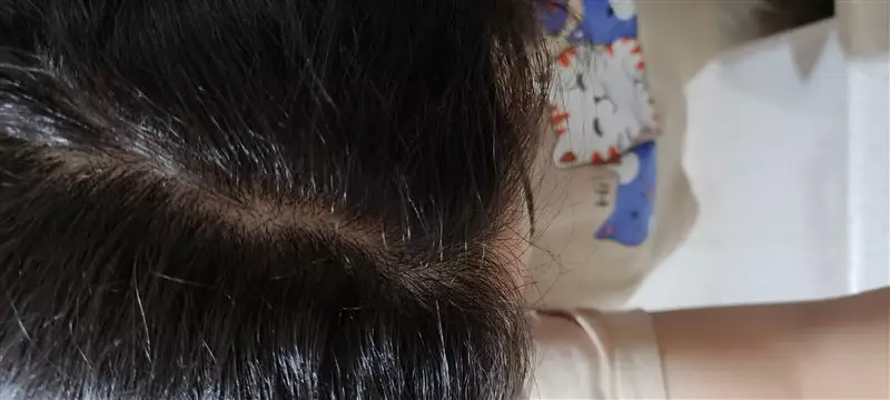 نتیجه مصرف تونیک ضد ریزش و تقویتی مو