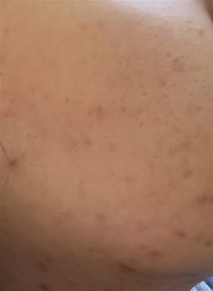 نتیجه مصرف صابون زردچوبه