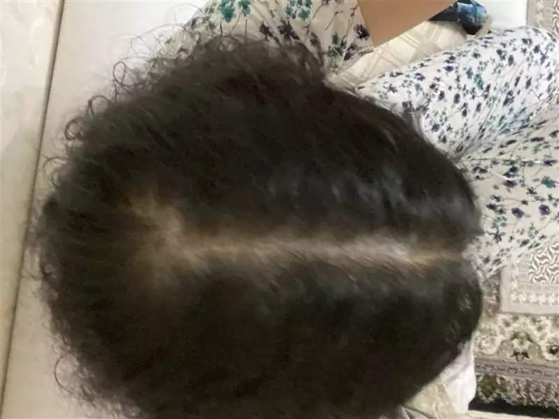 نتیجه مصرف تونیک ضد ریزش و تقویتی مو