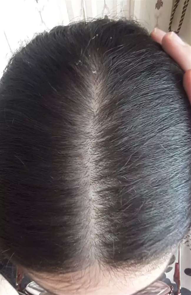 نتیجه مصرف تونیک ضد ریزش و تقویتی مو