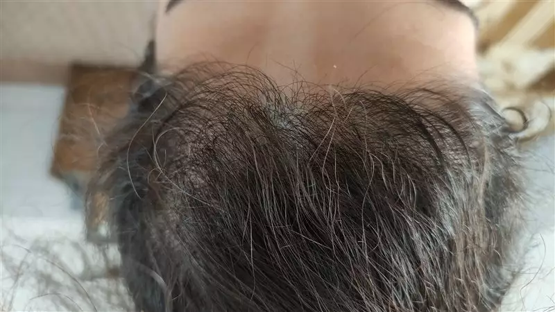 نتیجه مصرف تونیک ضد ریزش و تقویتی مو