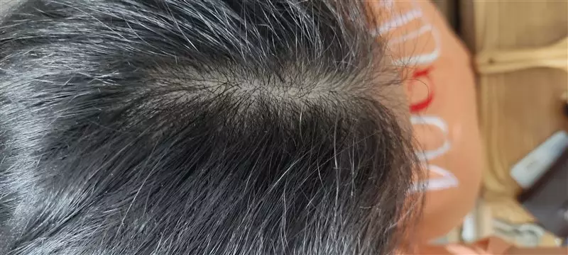 نتیجه مصرف تونیک ضد ریزش و تقویتی مو