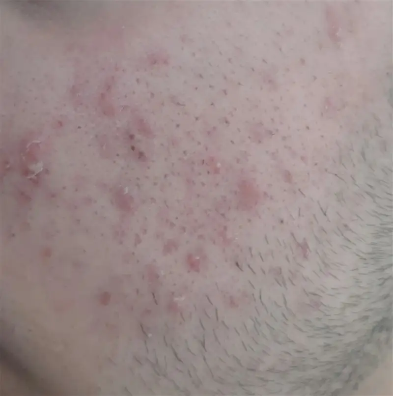 نتیجه مصرف خاک رس سبز