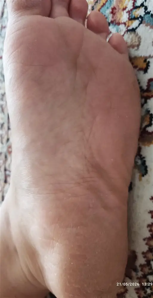 نتیجه مصرف شی باتر