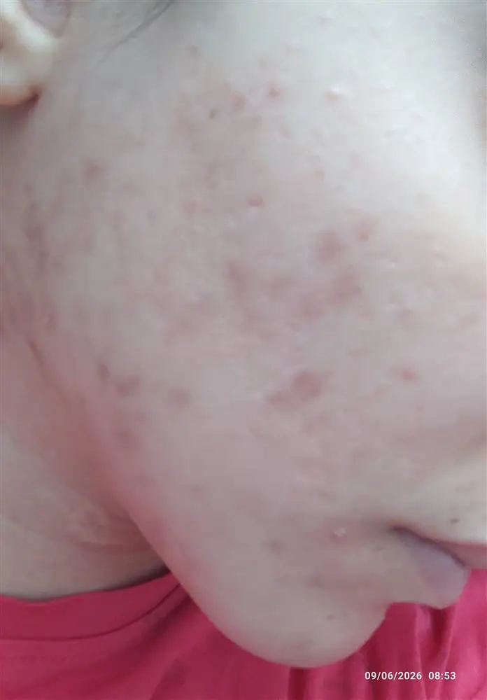 نتیجه مصرف پک مراقبتی پوست چرب (صورت)
