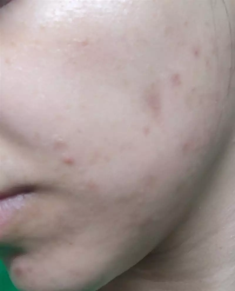 نتیجه مصرف صابون زردچوبه