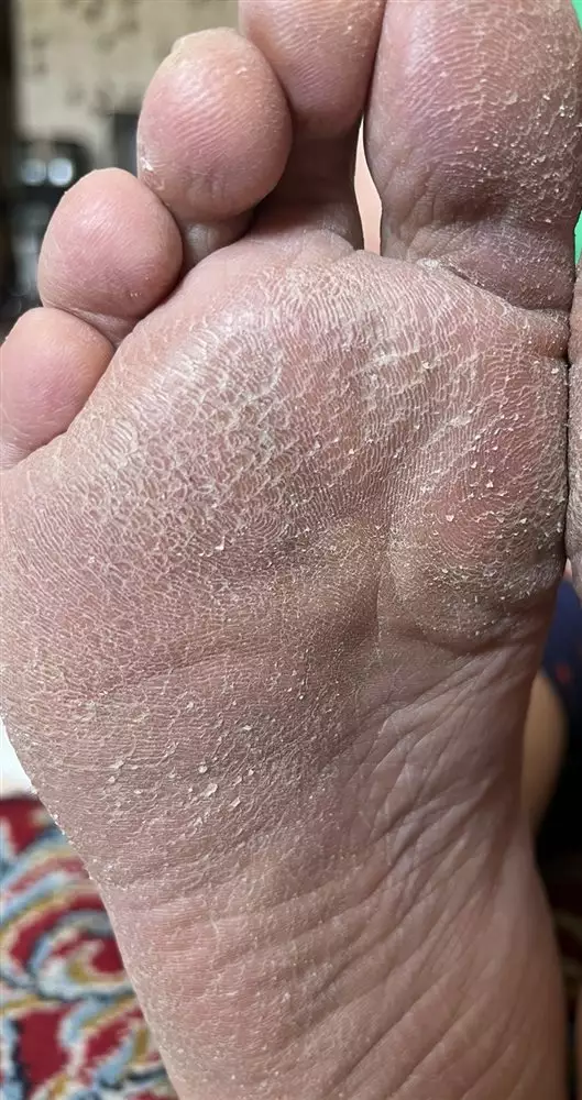 نتیجه مصرف شی باتر