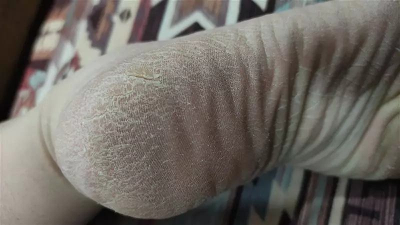 نتیجه مصرف شی باتر