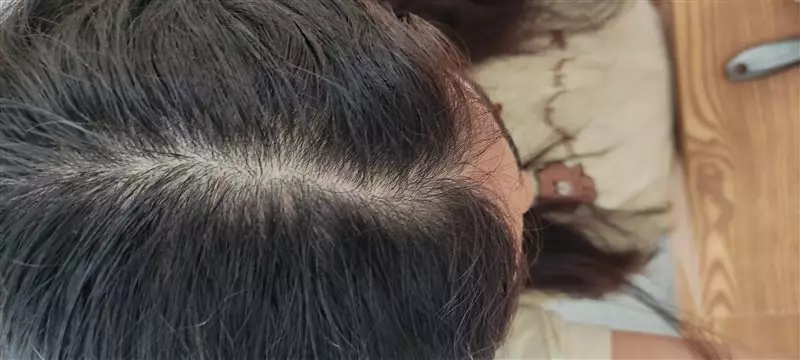 نتیجه مصرف پک مراقبتی ضد ریزش موهای چرب