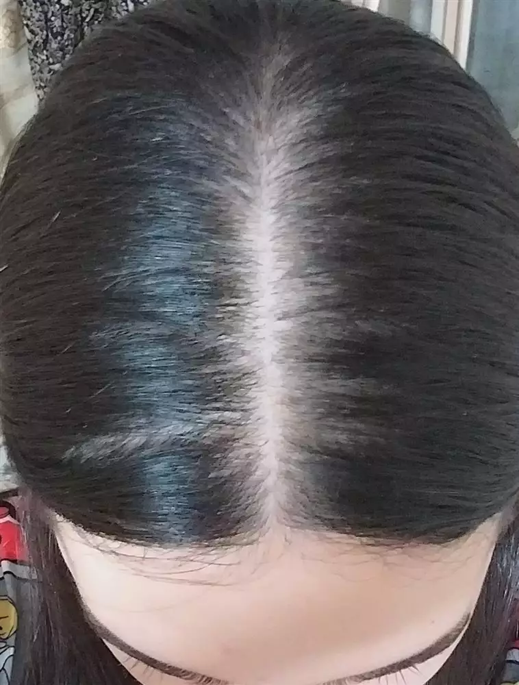 نتیجه مصرف تونیک ضد ریزش و تقویتی مو