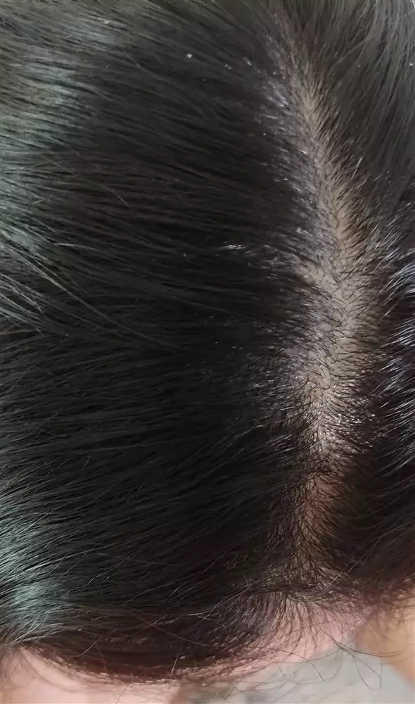 نتیجه مصرف شامپو موی چرب رپ رپ