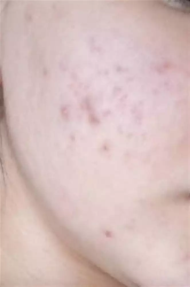 نتیجه مصرف صابون زردچوبه