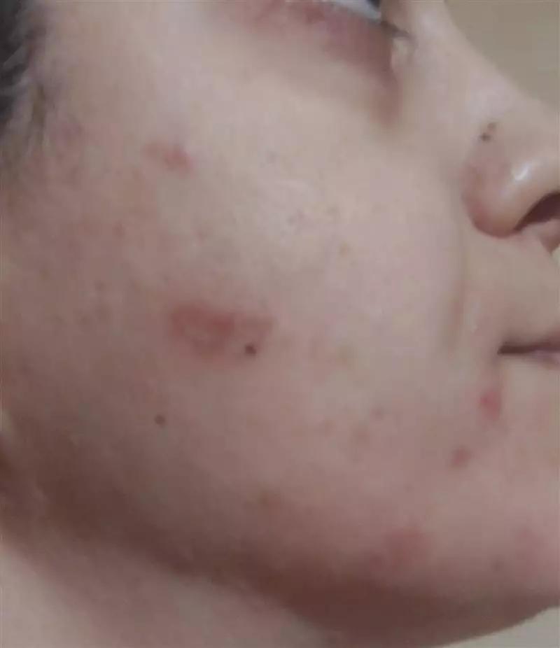 نتیجه مصرف ژل مغذی پوست اسپیرولینا