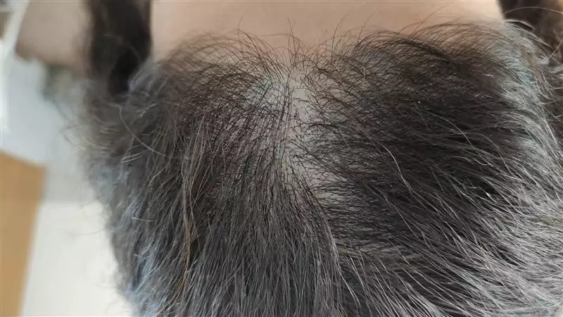 نتیجه مصرف تونیک ضد ریزش و تقویتی مو