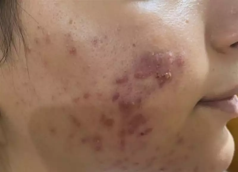 نتیجه مصرف صابون زردچوبه