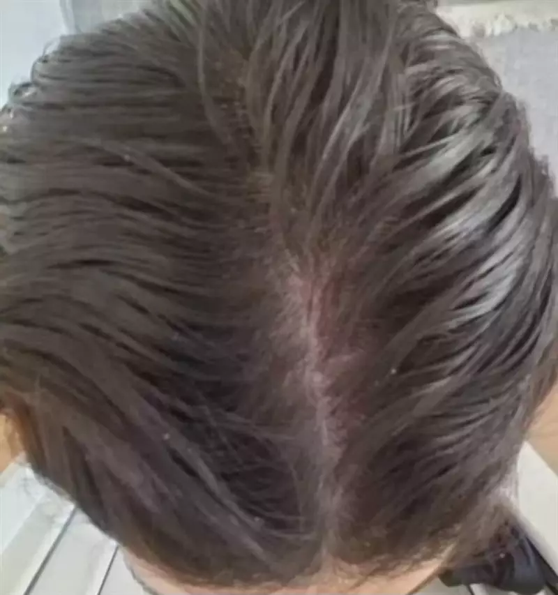 نتیجه مصرف تونیک ضد ریزش و تقویتی مو