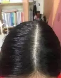 نتیجه مصرف تونیک ضد ریزش و تقویتی مو