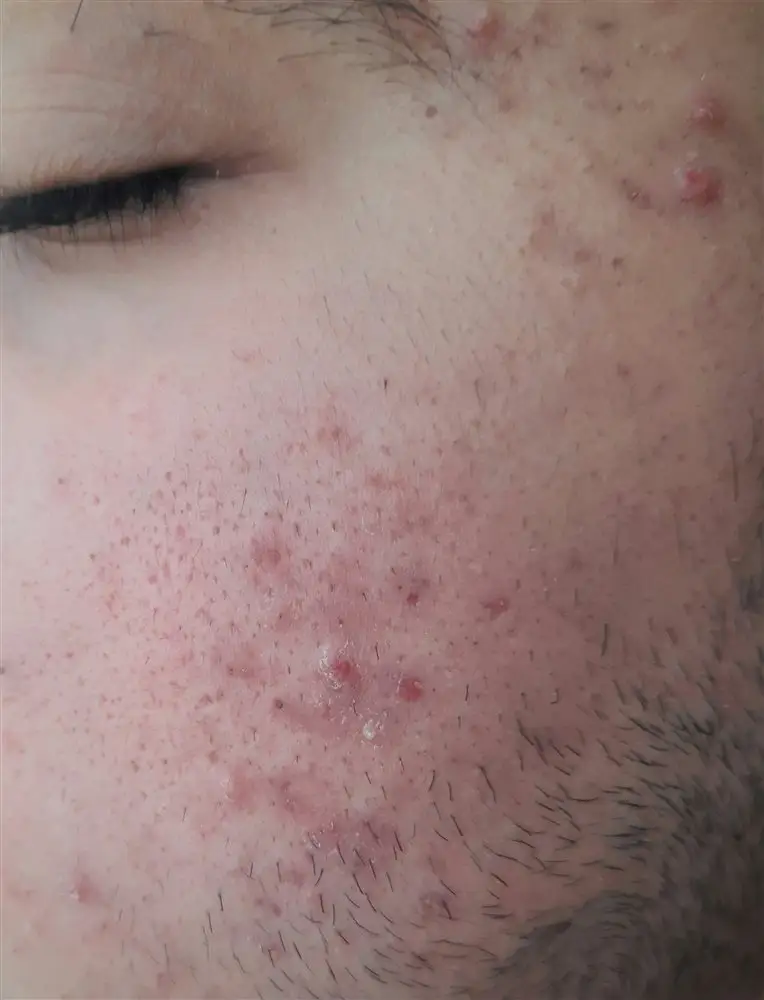 نتیجه مصرف خاک رس سبز