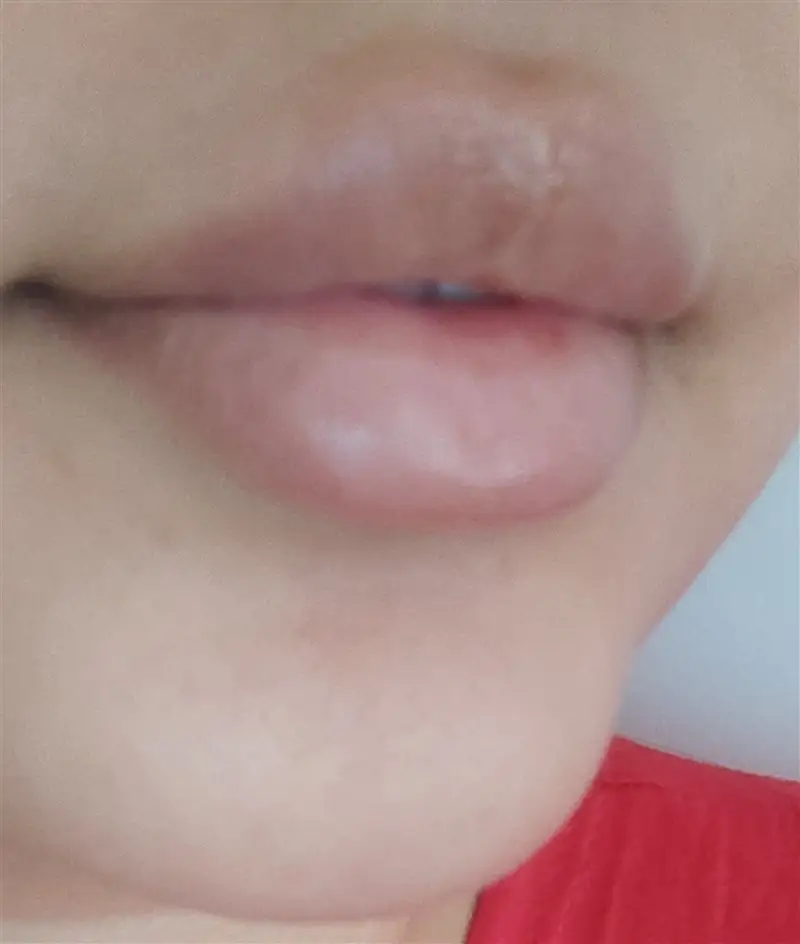 نتیجه مصرف تینت لب