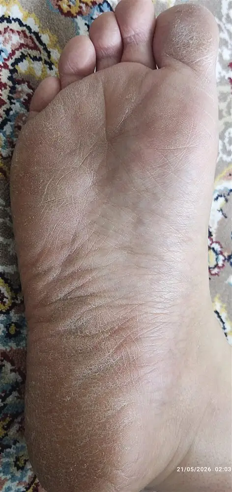نتیجه مصرف شی باتر