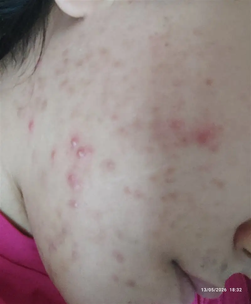 نتیجه مصرف پک مراقبتی پوست چرب (صورت)