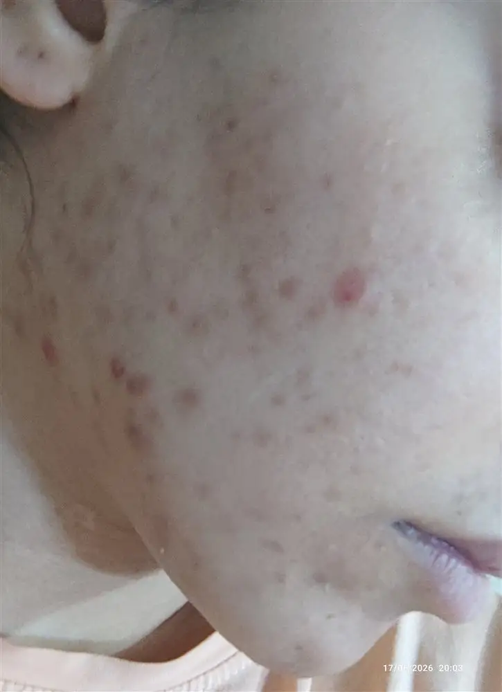 نتیجه مصرف روغن درخت چای