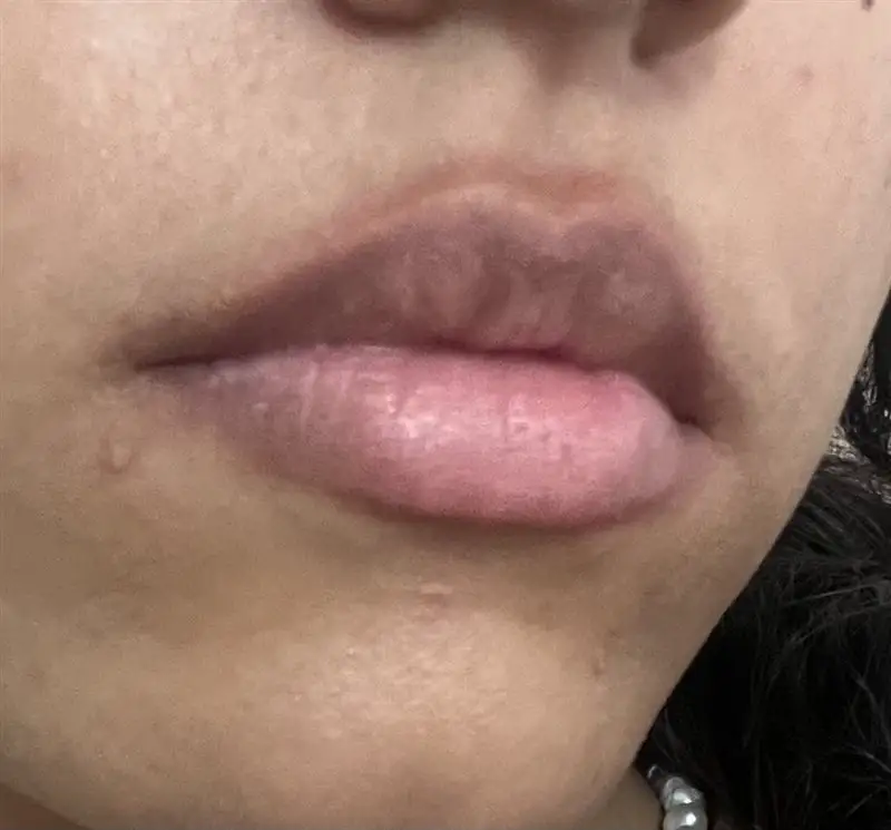 نتیجه مصرف تینت لب