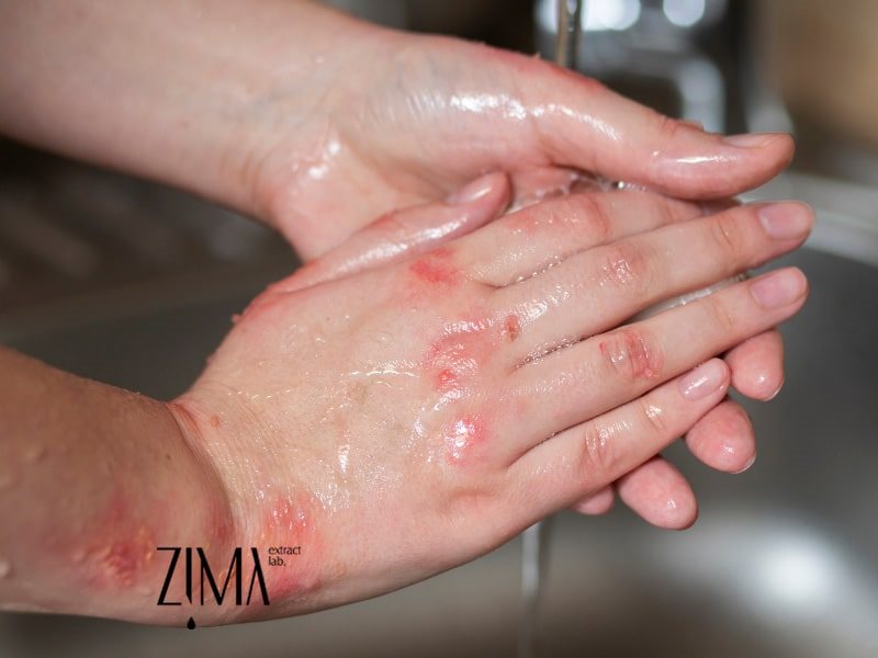 روغن برای سوختگی