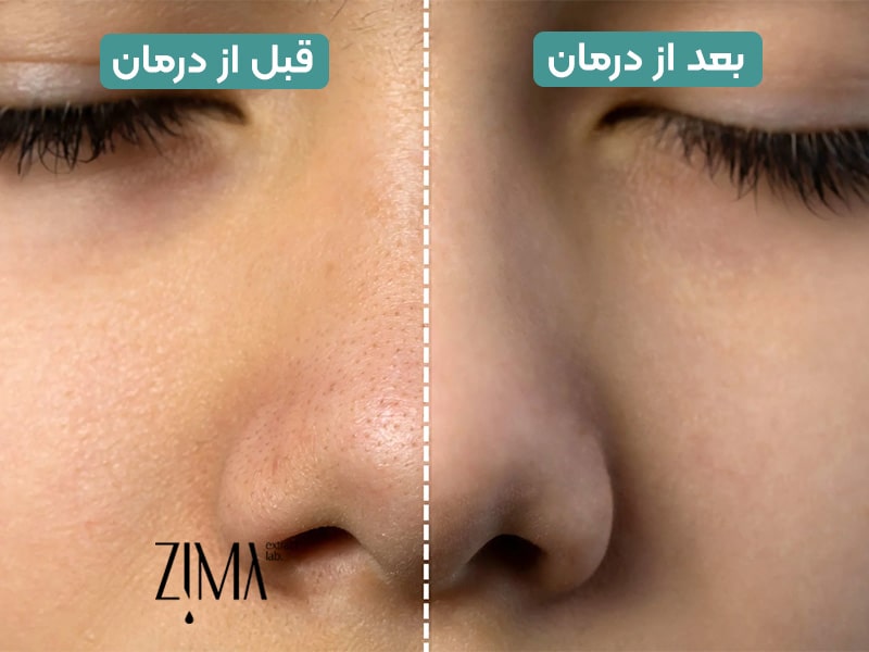 عکس قبل و بعد از درمان منافذ باز پوست