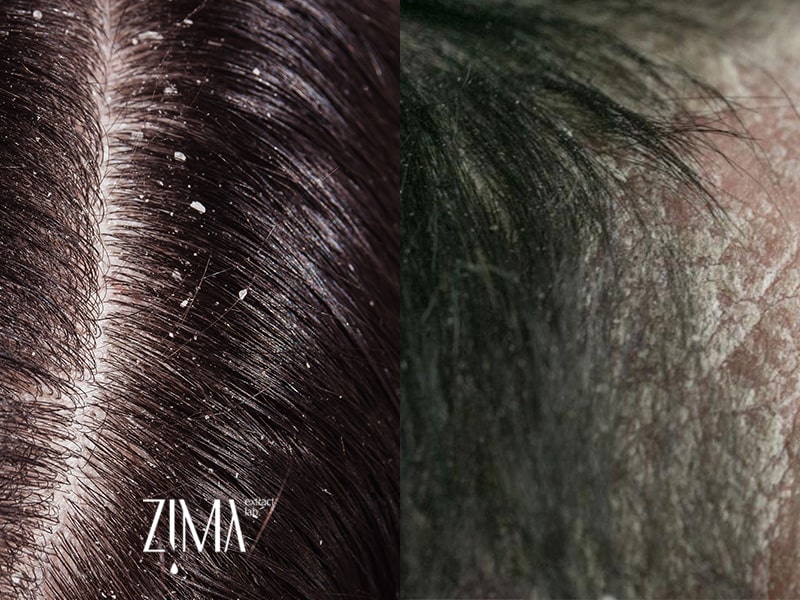 عکس پوسته پوسته شدن سر با شوره سر