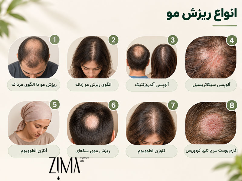 انواع ریزش مو