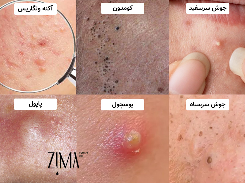 انواع جوش روی پوست